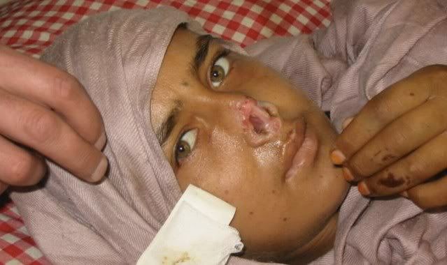 example-of-muslim-woman-with-nose-cut-off.jpg